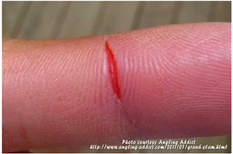 image of cut finger